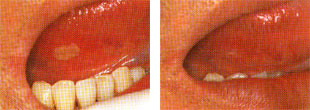 義歯による潰瘍や口内炎・口角炎